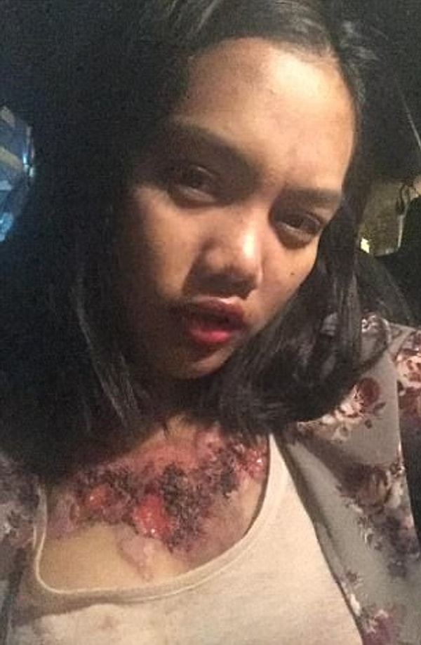 5. В феврале Рой удалила татуировку на груди, а через несколько дней после процедуры у нее появились зуд и жжение, начались невыносимые боли