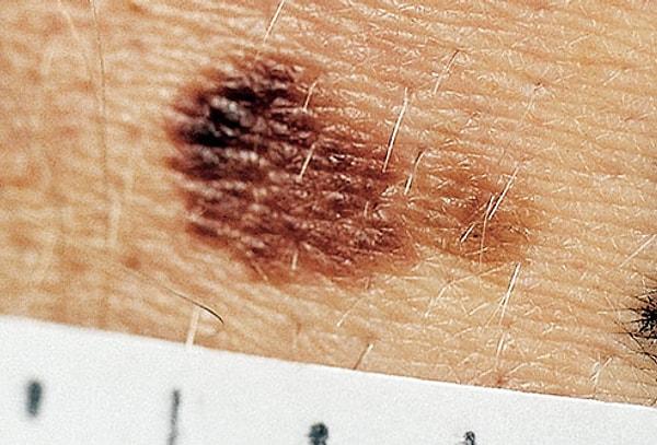 50'den fazla benin bulunduğu insanlarda melanom gelişme olasılığı yüksektir.