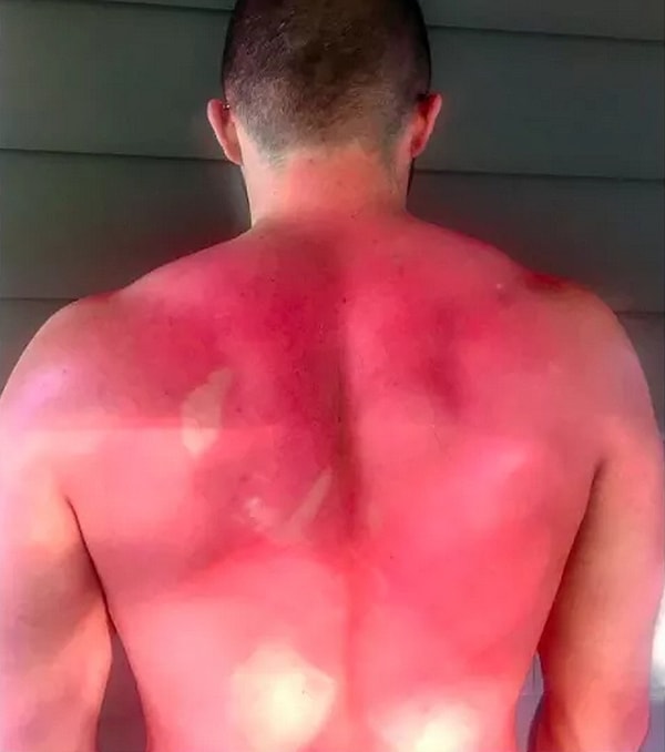 7. И препятствует появлению красивого загара!