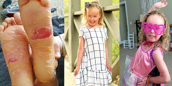 Ender Görülen Rahatsızlığı Yüzünden Sürekli Deri Değiştiren Küçük Kız!