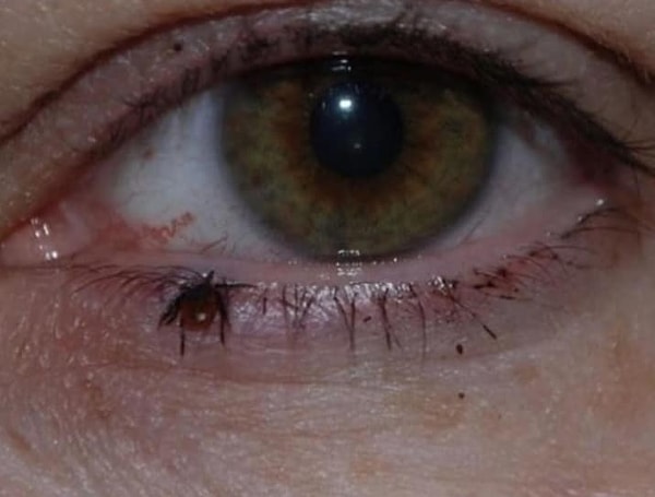 10. Просыпались ли вы когда-нибудь с зудящим глазом?