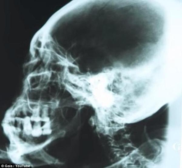 Yine ekibin iddialarına göre mumyanın kafasının röntgen filmi.