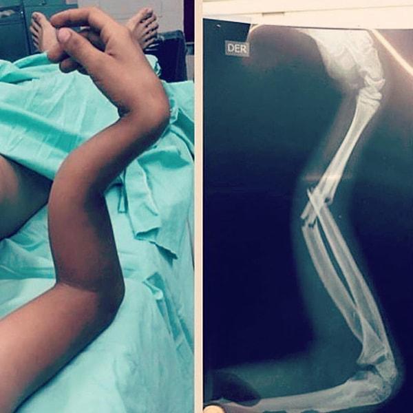 3. Kötü bir şekilde kırılmış kolun röntgeni.