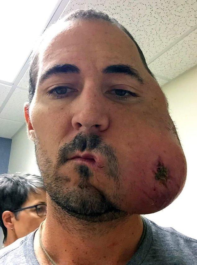 En sonunda McGrath'in yüzünün sol tarafı tümörle kaplandı. Öncelikle ameliyat olmamak için, başka alternatifleri denedi. Ama 18 ay sonra ameliyata mecbur kaldı.