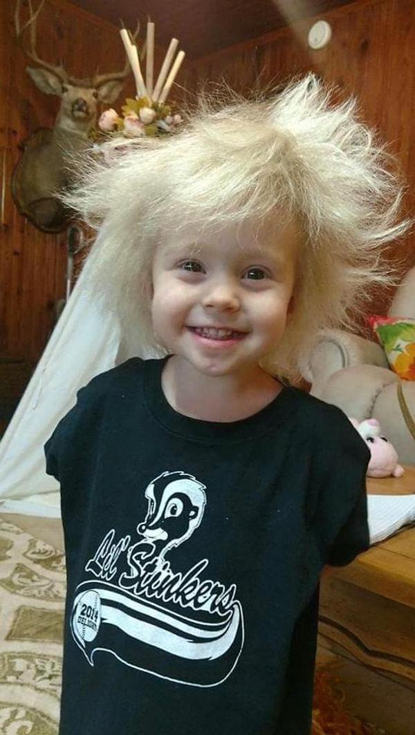 İki buçuk yaşındaki Jaili Lamb, 'Taranamayan Saç Sendromu' adlı bir saç hastalığına sahip.