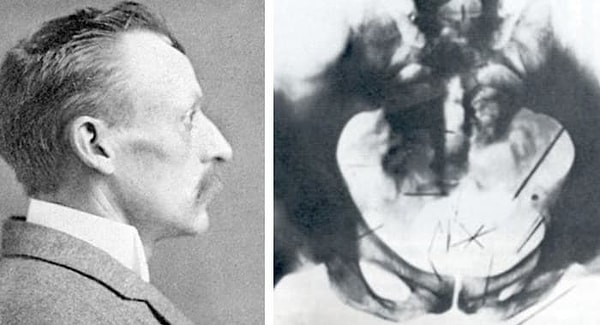 10. Альберт Фиш втыкал иголки в свои половые органы, потому что его возбуждала боль.