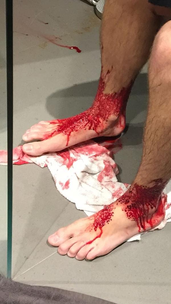 Sam kanı temizleyince bacaklarındaki minik delikleri fark etti.