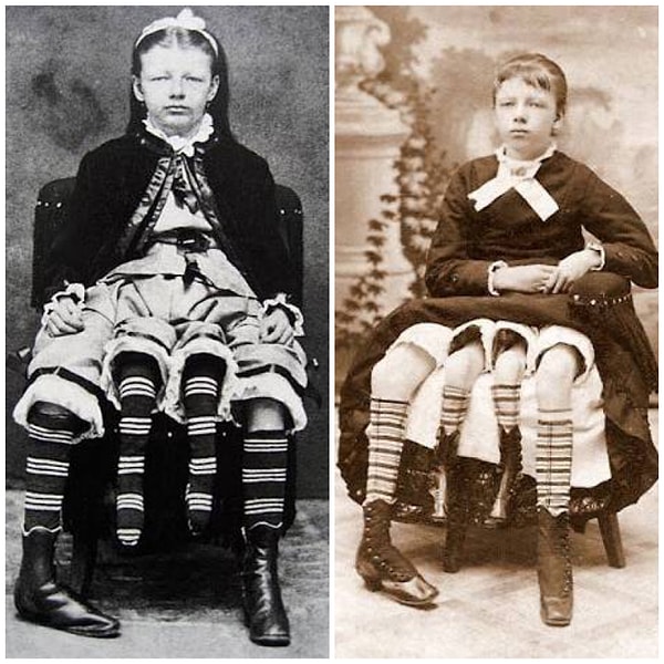 9. Жозефина Мертл Корбин - "четырехногая девочка из Техаса".