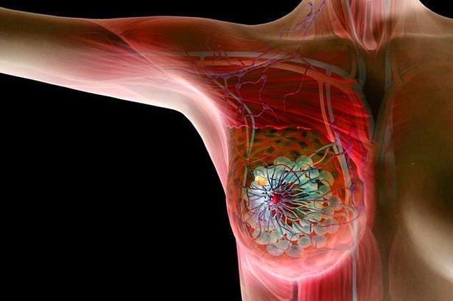 6. Dünyada kadınlarda görülen en yaygın kanser göğüs kanseridir.