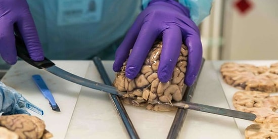 Beyninizi Bağışlarsanız Ne Olur? Laboratuvarından Gerçek Görüntülerle 250 Parçaya Bölünen Beyinler!