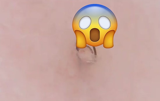 Batık Kıl Çıkarma Görüntüleriyle, Hastasına Dünyaları Vadeden Instagram Hesabı: Tweezist