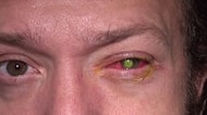 Kullandığınız Kontak Lens Sizi Kör Edebilir!