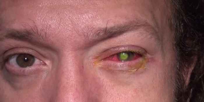 Kullandığınız Kontak Lens Sizi Kör Edebilir!