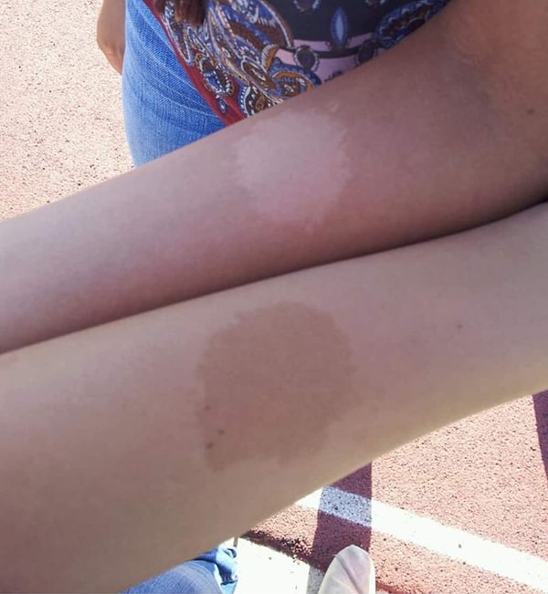 18. Такие родимые пятна появляются, когда рука плода плотно и слишком долго прилегает к животу.