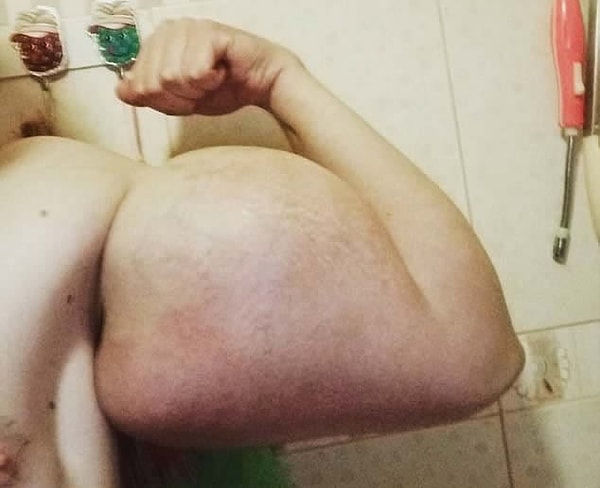 6. Также сам Терешин признается, что после инъекций у него поднимается температура под сорок.