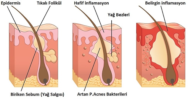 Yiyecek alerjisinin de bu sorunu artırdığı düşünülüyor.