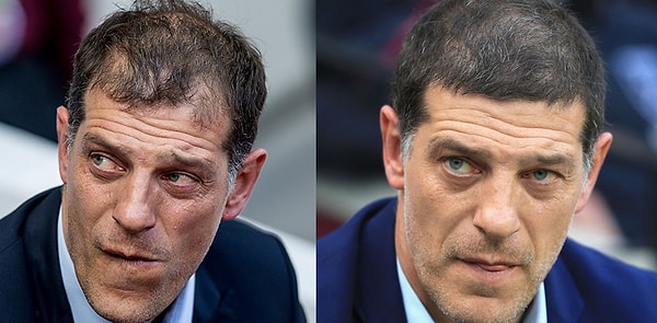 Пересаженные волосы