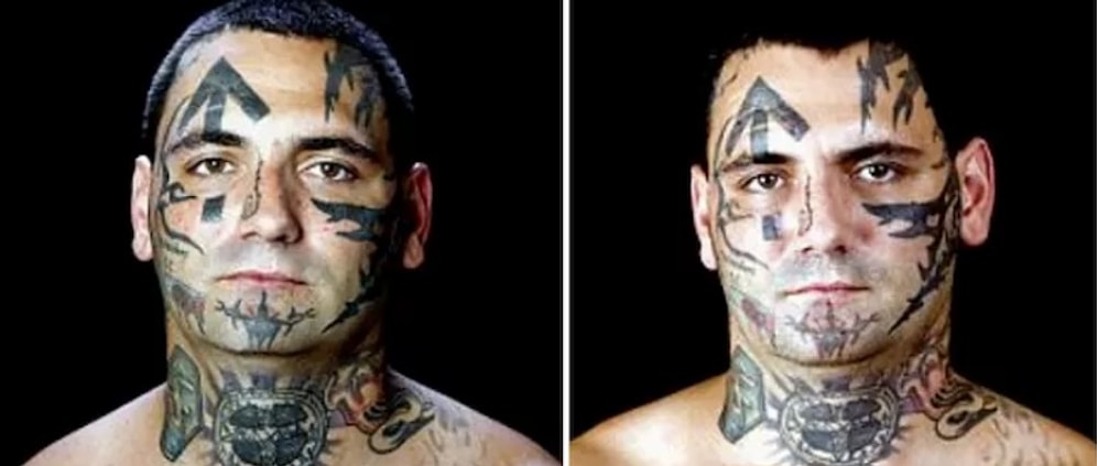После 25 операций этот бывший лидер банды скинхедов свободен от татуировок и ненависти