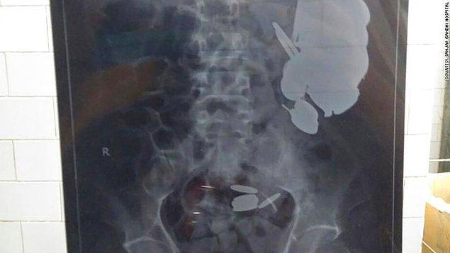 Yeni Delhi'de yaşayan 28 yaşındaki Maksood Khan anormal derecede şiddetli ağrılarından ötürü hastaneye gitti.