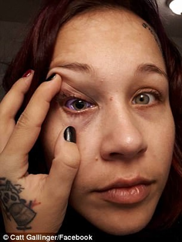 2. В сентябре этого года девушка решила сделать себе татуировку на белок глазного яблока: раскрасить его в сиреневый цвет.