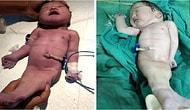 Ребенок, появившийся на свет в Индии с синдромом русалки, умер через 4 часа после рождения