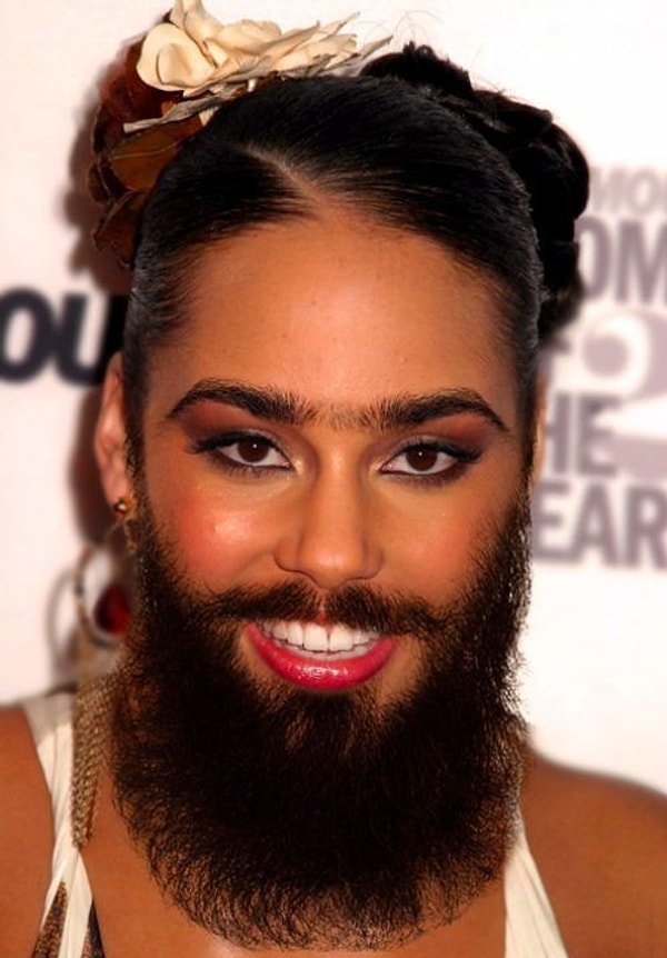 1. Гирсутизм — избыточный рост жестких темных волос у женщин на лице, спине, грудной клетке