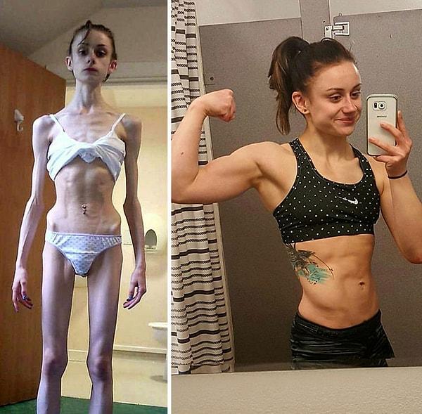 4. "Anoreksiya ve sonrası"