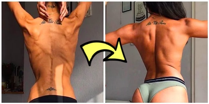 Azmin Zaferi! Anoreksiya Hastalığını Yenip Kilo Alanların Yaşadığı Efsanevi Değişimler! 💪