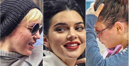 11 знаменитостей, о проблемах с кожей которых вы даже не подозревали