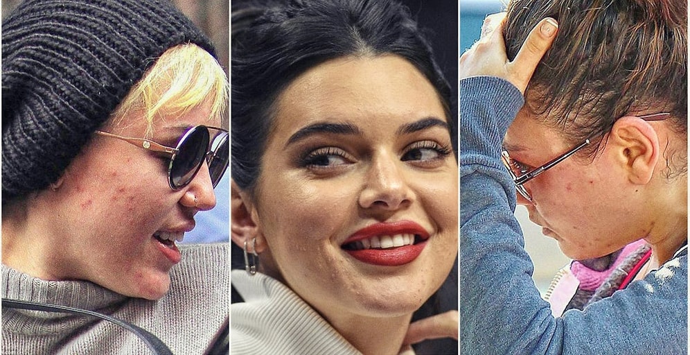 11 знаменитостей, о проблемах с кожей которых вы даже не подозревали