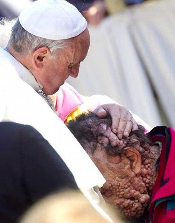 11. Nörofibromatozis hastasını samimiyetle kucaklayan Papa Francis.