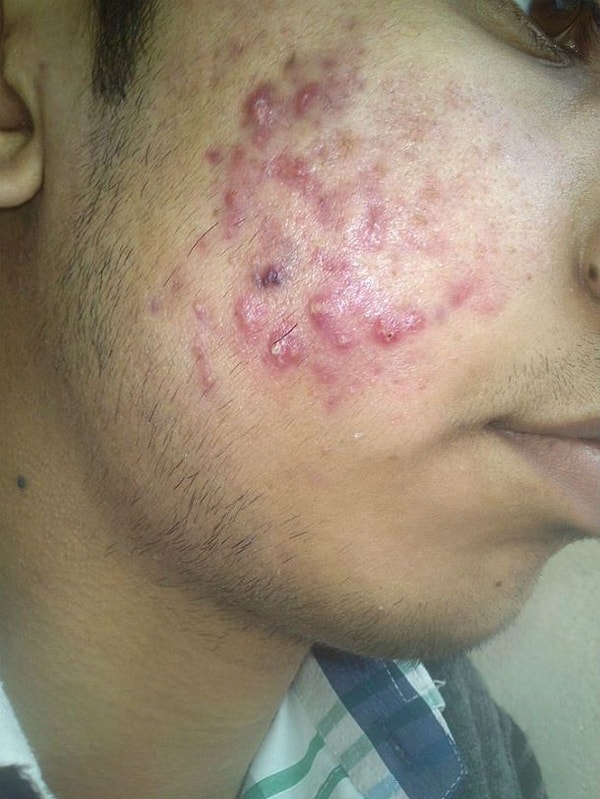 4. Раздражение и прыщи на коже