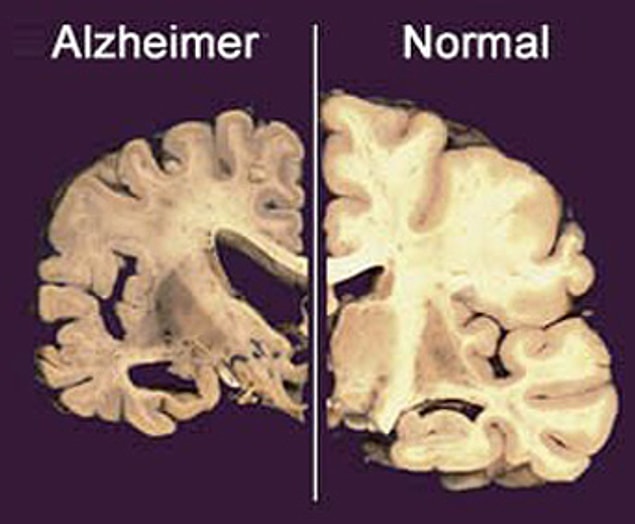Her ne kadar vücudumuz alüminyumu başarıyla dışarı atabilse de, diyetle alınan alüminyumun Alzheimer hastalığının gelişiminde potansiyel bir faktör olduğu öne sürülmüş.