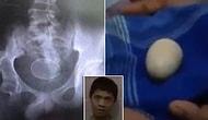 Индонезийский мальчик, вот уже два года якобы регулярно несущий яйца, шокировал врачей!