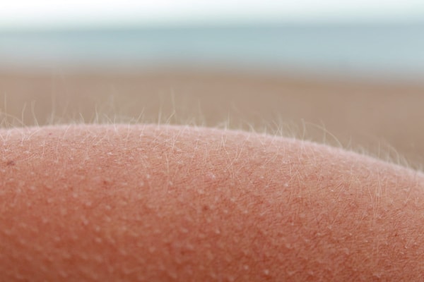 12. На теле умершего человека можно увидеть «гусиную кожу».