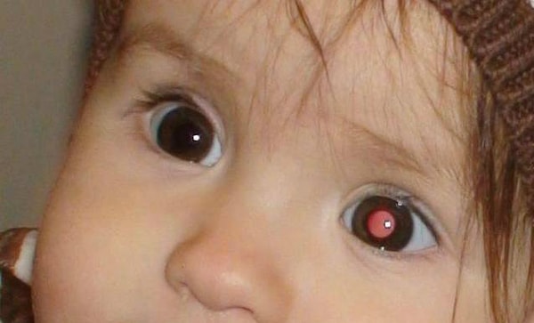 3. Если вы видите, что у человека на фото один глаз «красный» от вспышки, а другой нет, то это может оказаться признаком ретинобластомы, злокачественной опухоли сетчатки глаза.