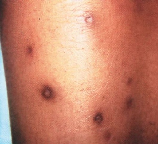 2. Коричневато-красные болезненные подкожные узелки преимущественно в области голеней.