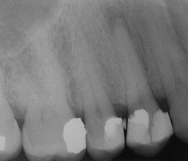 4. Проблемы с деснами указывают на сердечные заболевания