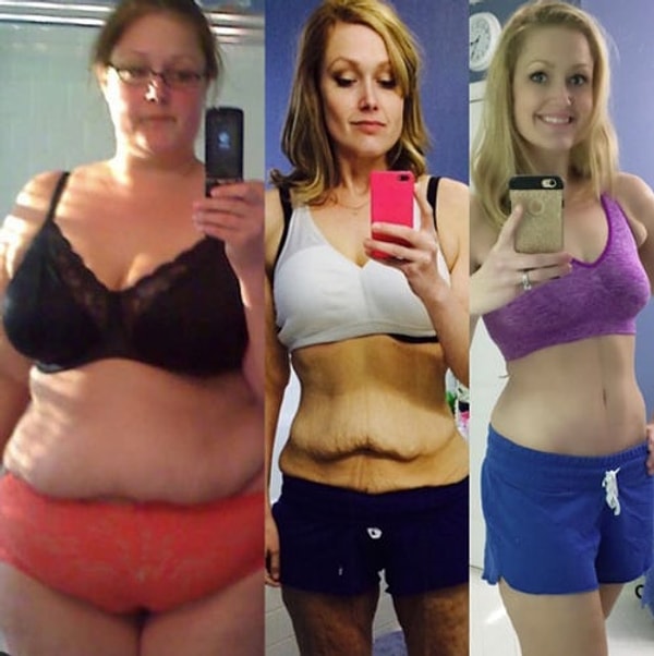 После того как ей обрезали лишнюю кожу, девушку стала весить 70 кг.