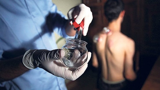 Sağlıkta Yeni Dönem: Hacamat, Sülük, Akupunktur Gibi Alternatif Tıp Tedavileri SGK Reçetesine Giriyor