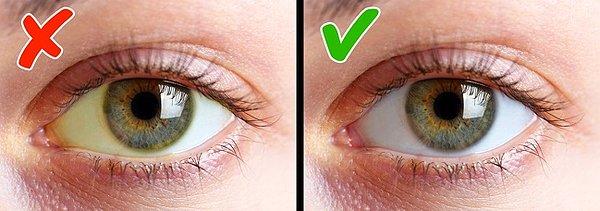 6. Gözlerin beyazında meydana gelen sarılık