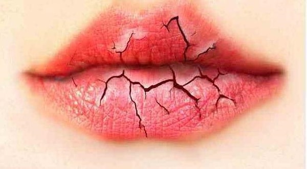 4. Потрескавшиеся губы