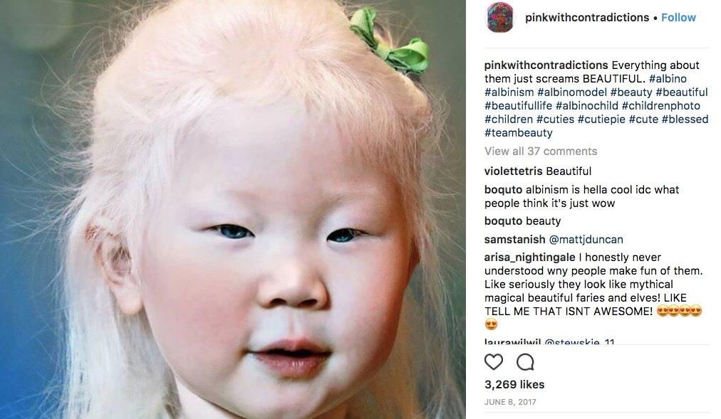 Дети альбиносы фото как выглядят