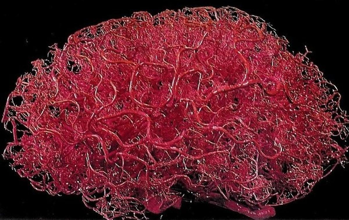 В мозге есть сосуды. Сосудистая мальформация головного мозга гистология. Кровеносные сосуды головного мозга. Капилляры головного мозга.