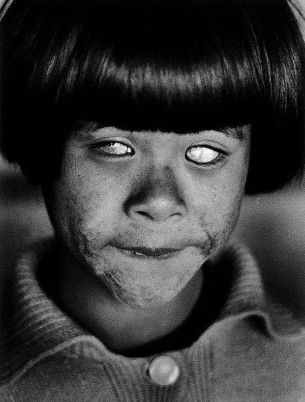 16. Hiroşima saldırısında görme yetisini kaybeden bir kız çocuğu.