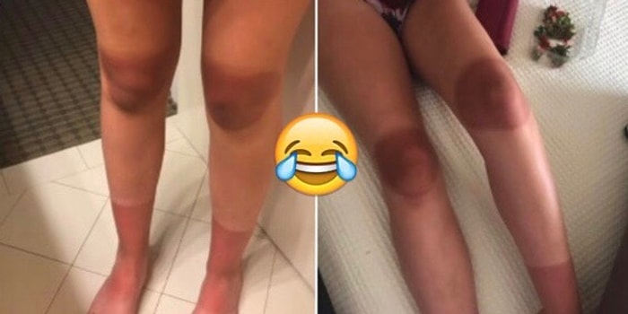 "Обугленные" коленки и загар в стиле "зебра": ну надо же было так облажаться?!