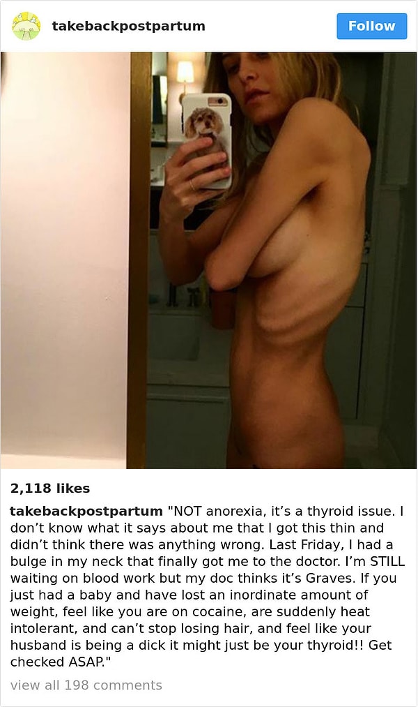 4. Это не анорексия, у женщины после родов начались проблемы со щитовидкой. Она начала стремительно сбрасывать вес и терять волосы. Врачи считают, что она не выкарабкается. Если такое случилось с вами, обязательно проверьтесь!
