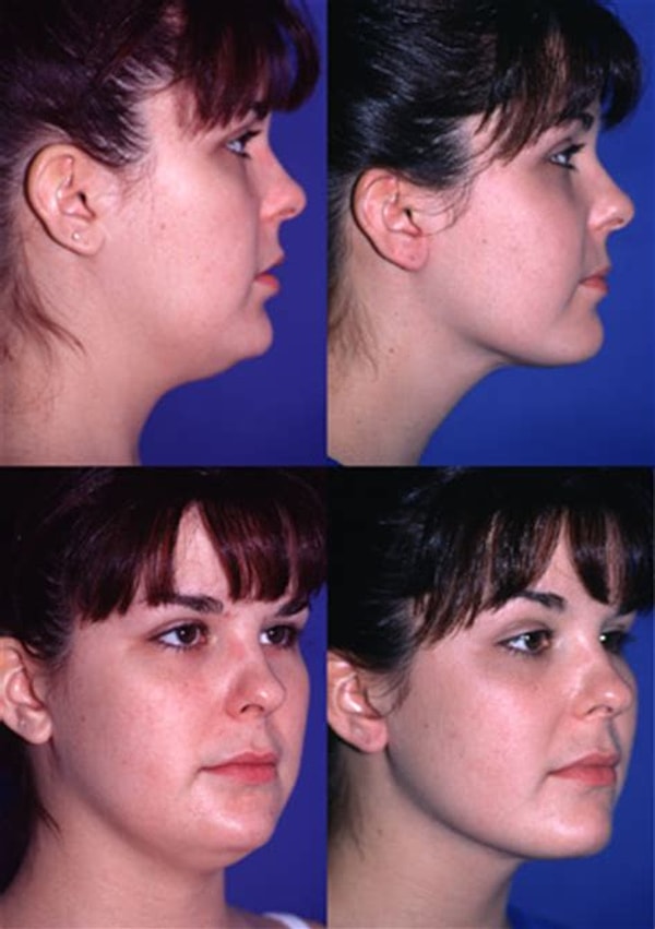 11. Липосакция лица