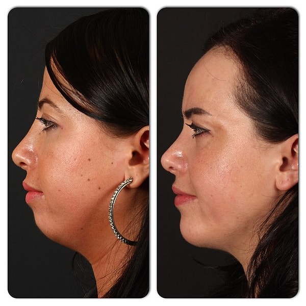 14. Увеличение лба