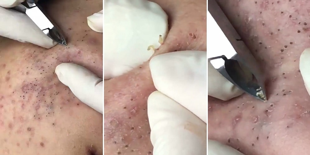 Hipnoz Etkili: İzlemesi Anlamsızca Tatmin Edici Olan Siyah Nokta Temizleme İşlemi